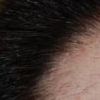 Alopecia areata