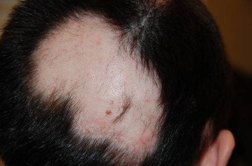 Alopecia areata