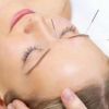 8 tratamentos que suavizam as rugas da testa - 2 Acupuntura