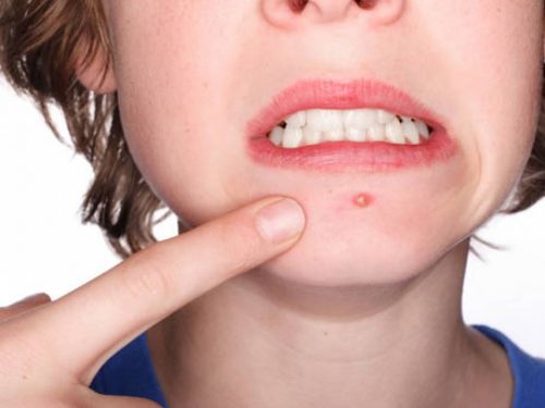 Acne: entenda as causas