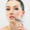 Estudo descobre vírus capaz de curar a acne