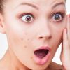 Saiba como evitar aparecimento e amenizar efeitos de cravos e acne