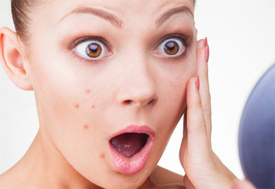 Saiba como evitar aparecimento e amenizar efeitos de cravos e acne