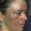 Mulher tem rosto queimado em tratamento e denuncia erro médico