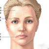 Botox para o tratamento de Paralisia Facial