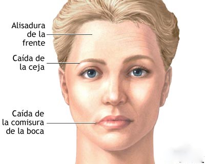 Botox para o tratamento de Paralisia Facial