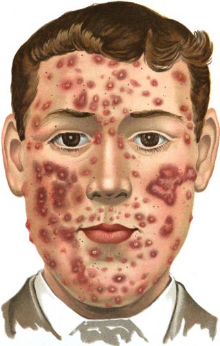 Acne e alimentação