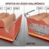 Ácido Hialurônico não pode faltar!