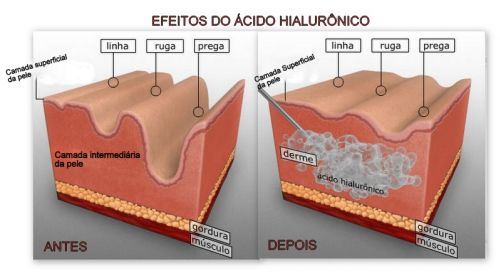 Ácido Hialurônico não pode faltar!