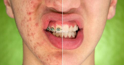 Tipos de cicatrizes de acne