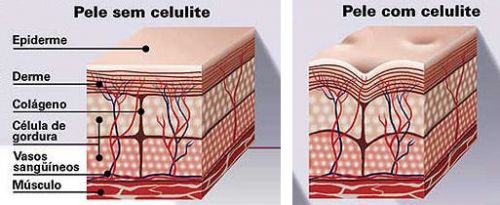 Patches Nanotecnológicos para a supressão total da celulite