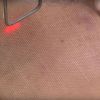 Laser CO2:  tratamento que elimina rugas e manchas da pele