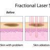 Uso dos lasers para tratamento de cicatrizes de acne