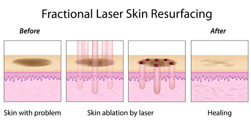 Uso dos lasers para tratamento de cicatrizes de acne