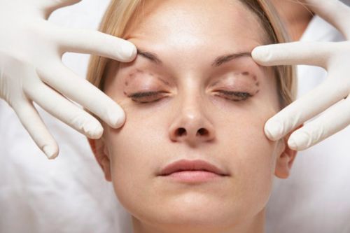 Blefaroplastia: o que é e quais são seus benefícios?