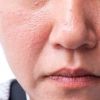 Por que os poros ficam dilatados? Saiba como cuidar e prevenir
